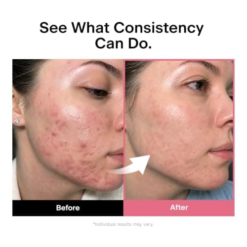 THOME Twenty Up, Clear Skin Duo Gentle At-Home Beauty Facial Device with Exosome amploule for Smooth & Clear-Looking Skin thumbnail 6