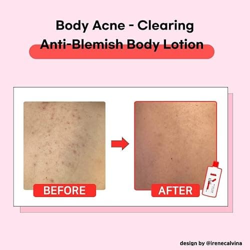 TIAM Anti-Blemish Body Lotion, 6.76 fl oz, Lightweight Body Acne Lotion with AHA, BHA, Niacinamide for Bacne, Buttocks, Chest Acne, Korean Skin Care thumbnail 4