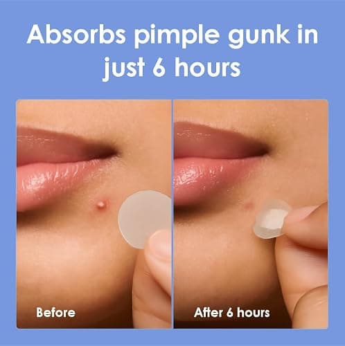 Pimple Patches for Face (1250 Count), Waterproof & Cut-to-Size Hydrocolloid Roll Tape, Absorb Gunk, Fast Healing & Hypoallergenic, Acne Patches Pimple Stickers for All Size Acne thumbnail 7