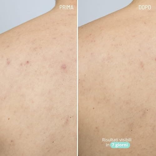 Freshly Cosmetics Siero corpo antiacne Azelaic Active Body Serum, 100ml thumbnail 3