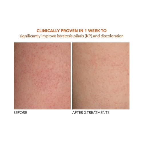 Dr Dennis Gross Alpha Beta Exfoliating Body Treatment | Multi-Tasking Powered by AHA/BHAs for Smooth, Hydrated Skin While Improving Ingrown Hairs, Keratosis Pilaris, and Blemishes | 8 Textured Towels - 1 Count (Pack of 1) thumbnail 7