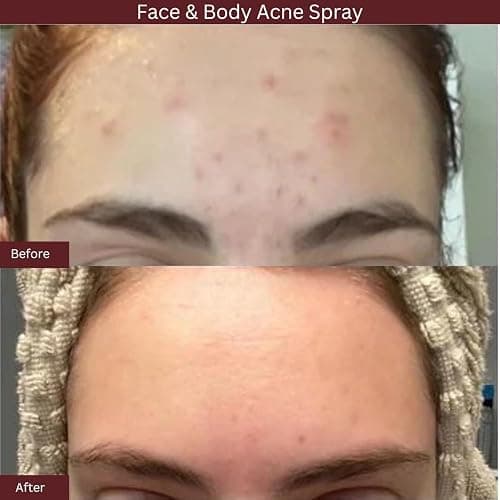 ITK Skincare 2% Salicylic Acid Spray for Face & Body Acne - Blemish-Fighting Treatment for Body Acne, Bacne, Blackheads, Pimples & Blemishes - BHA Blemish Facial Mist Post Workout - 3.3oz Spray Bottle thumbnail 4
