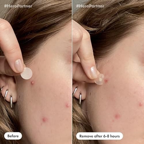 Mighty Patch™ Day and Night Patches – The Hydrocolloid Patch Duo Pack. Derm-Tested. Medical-Grade Hydrocolloid. Absorbs Pimple Gunk in 6-8 Hours. 36ct (18x Original, 18x Invisible+) thumbnail 5