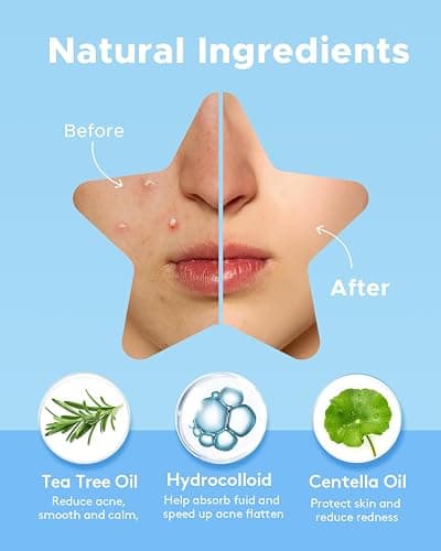LitBear Acne Pimple Patch, 6 Colors 168 Dots Star Pimple Patches with Tea Tree Oil & Centella Oil, Hydrocolloid Acne Patches for Face Cute Zit Patches Pimple Stickers Acne Dots thumbnail 3