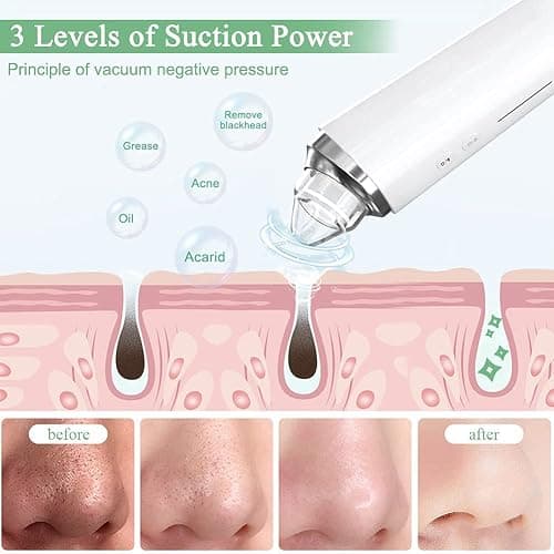 Blackhead Remover Pore Vacuum, 【[FDA Certification] 】 WiFi Visible Facial Pore Cleanser with HD Camera Pimple Acne Comedone Extractor Kit with 6 Suction Heads Electric Blackhead Suction Tool thumbnail 5
