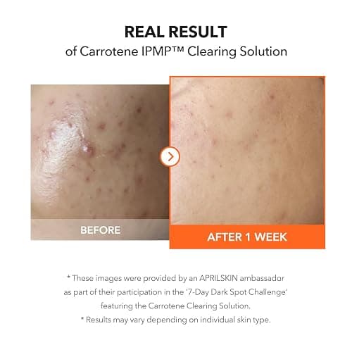 APRILSKIN Carrotene IPMP™ Clearing Solution || Quickly soothes troubled areas and helps clear blemishes | Formulated with BHA, AHA, Niacinamide & Zinc Oxide | Vegan, Cruelty-Free (0.67fl.oz.) thumbnail 6