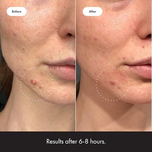 Mighty Patch™ Invisible+ Patch - Daytime Hydrocolloid Acne Pimple Patches for Covering Zits and Blemishes, Ultra Thin Spot Stickers for Face and Skin (24 Medium and 15 Small Patches) thumbnail 4
