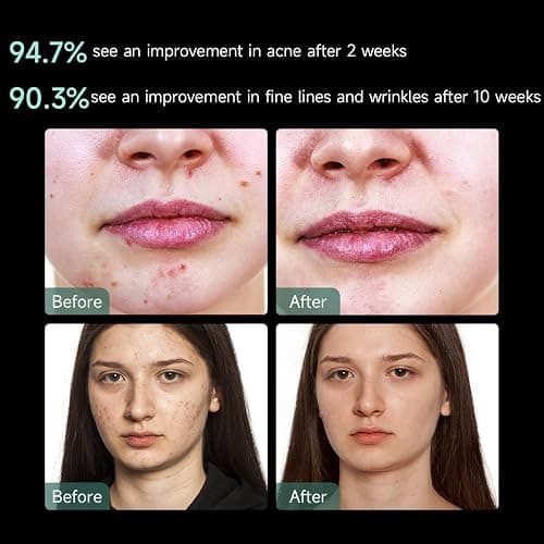 Aphrona® | FDA cleared Moonlight LED Facial Mask Skin Care Mask, Women mom wife lady gift, LED Light Therapy Red Blue light for Acne Removal Wrinkle Reduction thumbnail 3