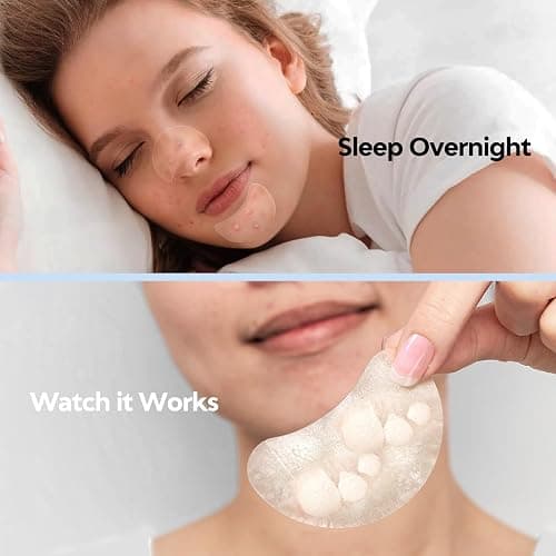 Large Pimple Patches for Face 331 Patches,Hydrocolloid Acne Patch Skincare Blemishes Zit Breakouts Bandages Big Spot Covers for All Skin Types w/Tea Tree Salicylic Acid & Cica Oil|Bigpack,Larger Size thumbnail 4
