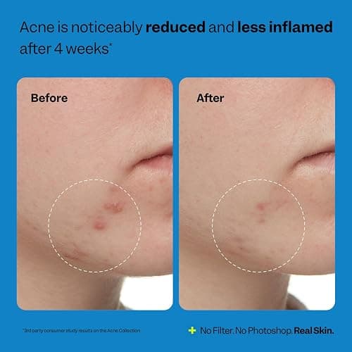 Peach Slices - Acne Exfoliating Toner (4.05 oz) - 2% Salicylic Acid Acne Treatment - Clear & Prevent Breakouts - Lactic & Glycolic Acid - Cucumber - Vegan, Cruelty Free, Korean Skin Care & Beauty thumbnail 6