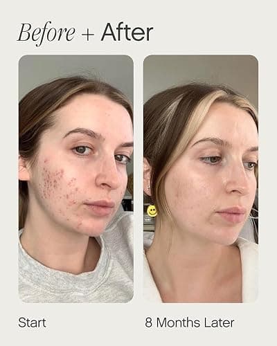 Topicals Faded Brightening and Clearing Serum | Reduces Discoloration, Post-Blemish Marks, Scars and Spots | Contains Kojic Acid and Niacinamide | Dermatologist-tested, Vegan, Cruelty-Free (0.5 Fl Oz) thumbnail 4