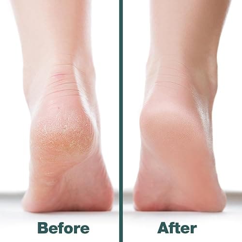 Probelle Double Sided Multidirectional Nickel Foot File Callus Remover - Immediately Reduces calluses and Corns to Powder for Instant Results, Safe Tool (Dark Grey) thumbnail 5