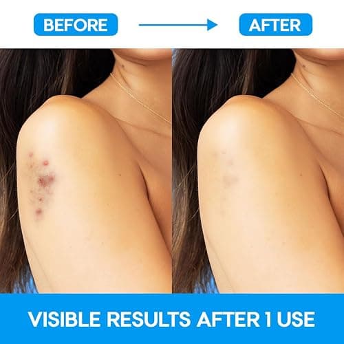 EZACNE™ Extra Large Pimple Patches for Body – Large Hydrocolloid Acne Patches for Back, Face, Forehead, Chin, Neck, Shoulders – Big Zit Patch for Breakouts (5 Count) thumbnail 5