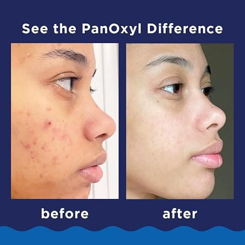 PanOxyl 10% Benzoyl Peroxide Acne Foaming Wash, Maximum Strength, Daily Acne-Fighting Face & Body Cleanser, Face Wash to Clear, Treat and Prevent Acne Pimples and Stubborn Breakouts, 5.5 Oz, Pack of 2 thumbnail 3