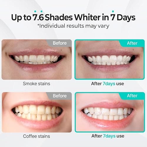 Live Orals PureDia Teeth Whitening Kit - Gel & Mouthpiece Set, Hydrogen Peroxide, Dentist Formulated for Sensitive Teeth, 28 Treatments. thumbnail 4