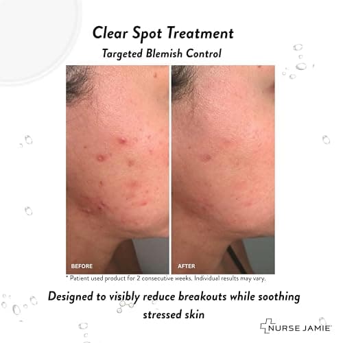 Nurse Jamie Clear Spot Treatment – Fast-Acting Overnight Blemish Treatment with Salicylic Acid, Glycolic Acid & Sulfur thumbnail 2
