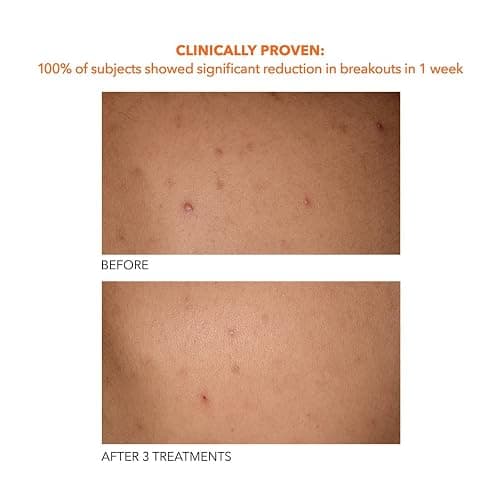 Dr Dennis Gross Alpha Beta Exfoliating Body Treatment | Multi-Tasking Powered by AHA/BHAs for Smooth, Hydrated Skin While Improving Ingrown Hairs, Keratosis Pilaris, and Blemishes | 8 Textured Towels - 1 Count (Pack of 1) thumbnail 8
