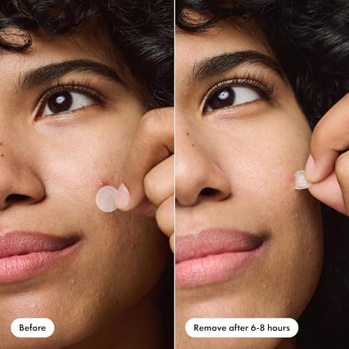 Mighty Patch™ Invisible+ Patch – The Barely-There Daytime Hydrocolloid Acne Pimple Patch for Covering Zits and Blemishes, Tapered Edges Designed to Blend Into Skin (72ct) thumbnail 5