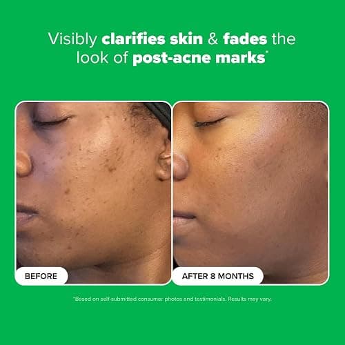 Paula's Choice BOOST 10% Azelaic Acid Booster Cream Gel Face Serum with Salicylic Acid, Oil-Free Skin Brightening Serum for Face, Fragrance-Free - 1 Ounce (Pack of 1) thumbnail 4