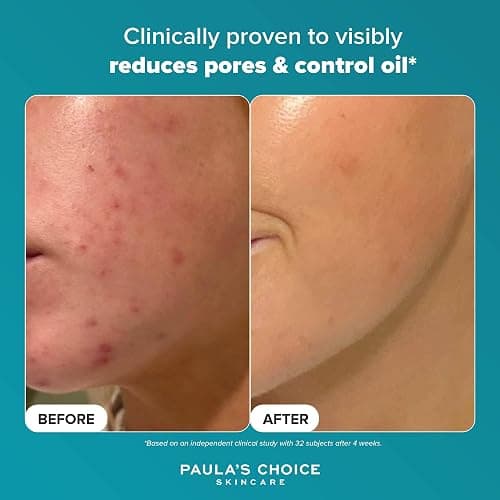 Paula's Choice SKIN PERFECTING 2% BHA Liquid Exfoliant - Face Exfoliating Peel Fights Blackheads & Enlarged Pores - for a Healthy Glow - with Salicylic Acid - Combination & Oily Skin - 30 ml thumbnail 5