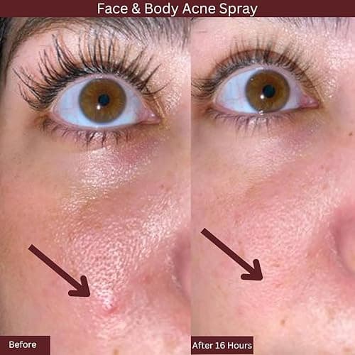 ITK Skincare 2% Salicylic Acid Spray for Face & Body Acne - Blemish-Fighting Treatment for Body Acne, Bacne, Blackheads, Pimples & Blemishes - BHA Blemish Facial Mist Post Workout - 3.3oz Spray Bottle thumbnail 5