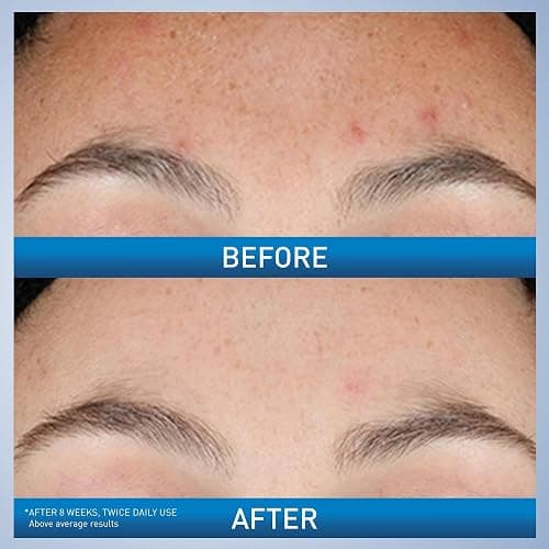 CeraVe Resurfacing Retinol Serum For Post Acne Marks, Formulated With Licorice Root Extract & Niacinamide, Brightening Serum & Pore Minimizer For Face, Post Acne Skin Barrier Repair, Non-Comedogenic thumbnail 3
