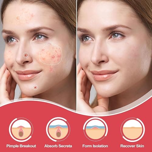 216 Counts Pimple Patches for Face, Hydrocolloid Acne Patches Zit Patches for Face Overnight Care Acne Spot Treatment Patch Cystic Acne Treatment Stickers Blemish Hydrocolloid Cover for all Skin Type thumbnail 2
