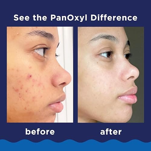 PanOxyl Acne Foaming Wash Benzoyl Peroxide 10% Maximum Strength Antimicrobial, 5.5 Oz thumbnail 6