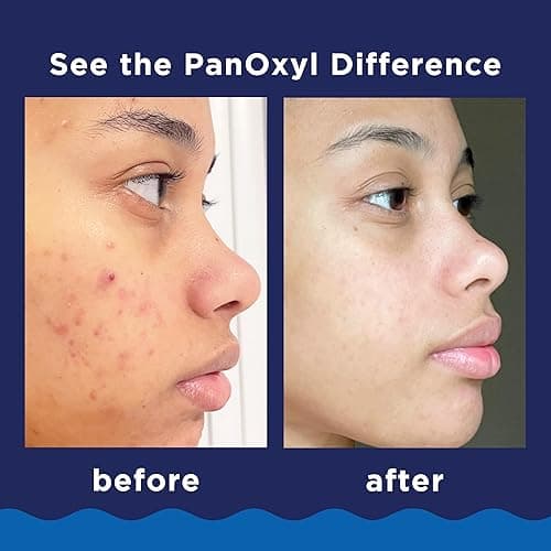 PanOxyl Acne Foaming Wash Benzoyl Peroxide 10% Maximum Strength Antimicrobial, 5.5 Oz - 5.5 Ounce (Pack of 1) thumbnail 6