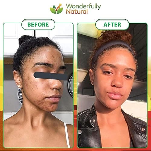 Wonderfully Natural #1 African Black Soap for Acne & Dark Spots | Organic Vegan Satisfaction Guarantee | 1lb bar 90 day Supply thumbnail 8
