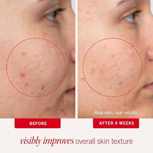 First Aid Beauty Acne Pads for Face - Maximum Strength Acne Treatment - 2% Salicylic Acid Pads Treat Without Drying, (60-ct) thumbnail 3