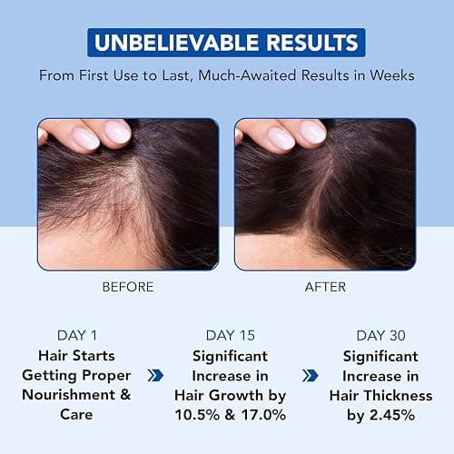 Botanic Hearth Rosemary Oil for Hair Growth - 6.7 Fl oz | Enriched with Biotin, Castor & Jojoba | Hair Relaxers & Dry Scalp Treatment | Color Safe | Suitable For All Hair Types thumbnail 4