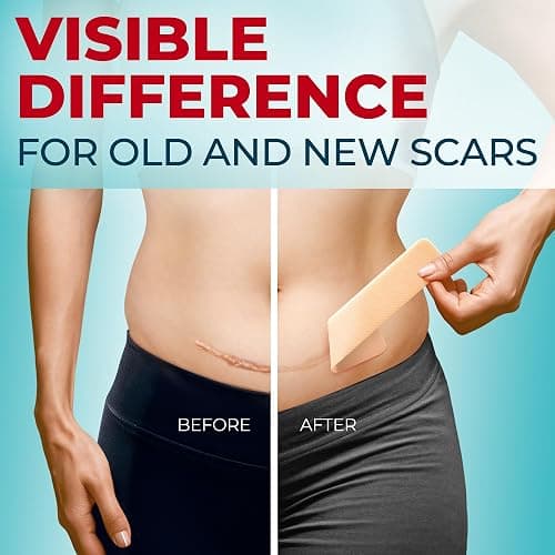 Medical Grade Silicone Scar Tape - 1.6”x150” - Visible Difference on Keloid & С-Section - Reusable Silicone Scar Sheets - Easy to Use - 150"x1.6" - Beige thumbnail 2