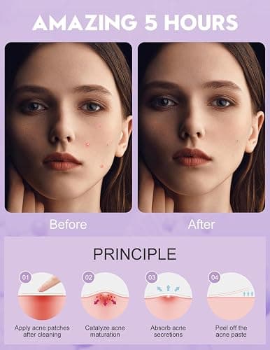 WakeALL Hydrocolloid Patches for Face, 5 Sizes (8/10/12/14/16mm) - Invisible Round Blemish Patches, Fluid-Absorbing Spot Stickers for Precise Fit, Individually Wrapped, Travel-Friendly 108 Count Box thumbnail 5