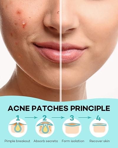 TKTK Pimple Patch Acne Patch, 4 Sizes 560 Patches Acne Absorbing Cover Patch, Hydrocolloid Invisible Acne Patches For Face Zit Patch Acne Dots Tea Tree, Calendula Oil - 4 Pack thumbnail 6