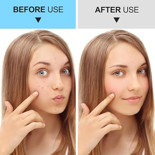 Pimple Popper Tool Kit Blackhead Remover Tools (5 Piece Kit), Professional Stainless Black Head Remover for face, Risk Free Treatment Pimple Extractor with Tweezers thumbnail 6