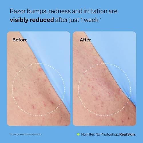 Peach Slices - Smoothing Solution Ingrown Hair Treatment (1.69 oz) - Smooth, Relieve, Soften Skin - 360 Roller - BHA, AHA, PHA, Niacinamide, Licorice - Vegan & Cruelty Free - Korean Skin Care & Beauty thumbnail 6