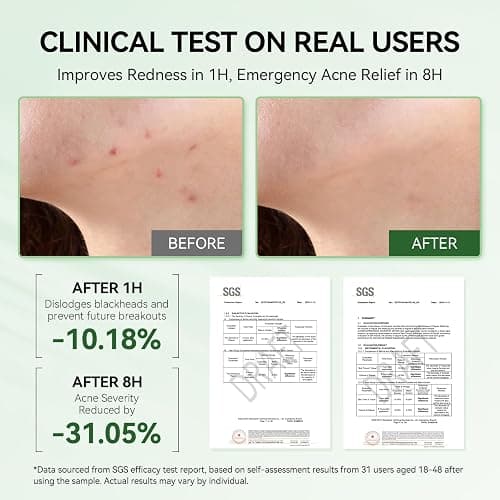 LANBENA 2% Salicylic Acid Spot Serum, 8H Rapid Acne Treatment for Acne-Prone Sensitive Skin, Fast-Acting Dry Out Pimples, Fade Acne Marks, Redness Relief, Overnight & Period Breakouts, 0.42 Fl Oz thumbnail 5
