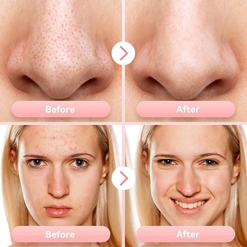 Blackhead Remover Pore Vacuum Upgraded Facial Pore Cleaner Electric Comedone Whitehead Extractor Tool-5 Suction Power,5 Probes,USB Rechargeable Blackhead Vacuum Kit for Women & Men thumbnail 6