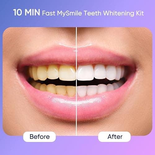 MySmile Deluxe 10 Min Teeth Whitening Kit with 28 LED Light, 35% Carbamide Peroxide Teeth Whitening Gel, Helps Remove Years of Stains from Coffee, Soda, Wines, Smoking, Food thumbnail 2