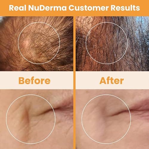 Pure Daily Care NuDerma Handheld Skin Therapy Wand Machine w/Neon – Anti-Aging - Skin Tightening - Wrinkle Reducing - Dark Circles – Clarifying - Hair & Scalp Stimulator thumbnail 7