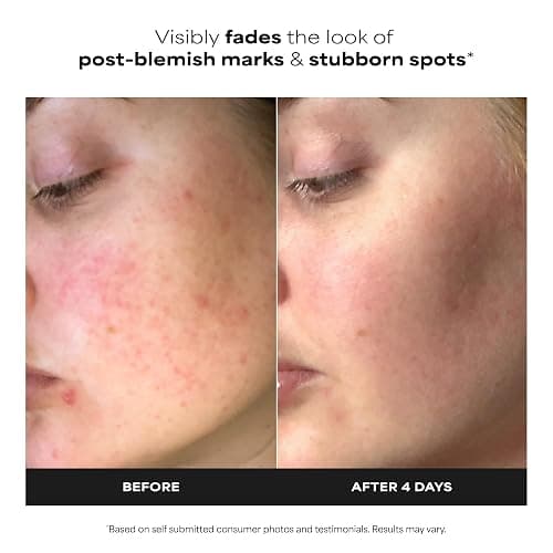 Paula's Choice BOOST 10% Azelaic Acid Booster Cream Gel Face Serum with Salicylic Acid, Minimizes Look of Redness & Fades Discoloration, Oil-Free Skin Brightening Serum for Face, Fragrance-Free thumbnail 2