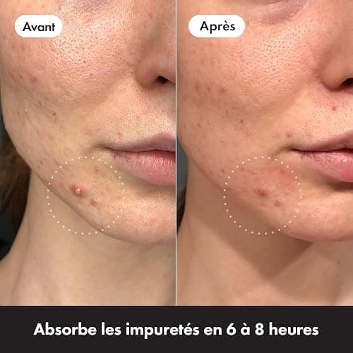 Hero Cosmetics Mighty Patch Original – Patch Bouton Nuit – Résultats en 6H – Technologie Hydrocolloïde – Absorbe les Impuretés & Réduit les Boutons – Format 36 Patchs thumbnail 5