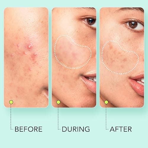 LitBear Large Pimple Patches (7 Sizes 306 Patches), Big Acne Patches, XL Hydrocolloid Bandages for Full Face, Forehead, Chin, Nose, Body, Back, Neck & Chest, Oval, Moon, Square hydrocolloid Patch thumbnail 5