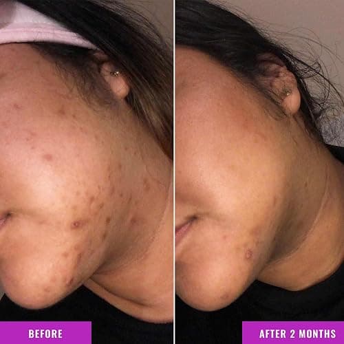Good Molecules Discoloration Correcting Serum - Tranexamic Acid and Niacinamide Serum to Target Dark Spots and Hyperpigmentation - Skin Care for Face thumbnail 4
