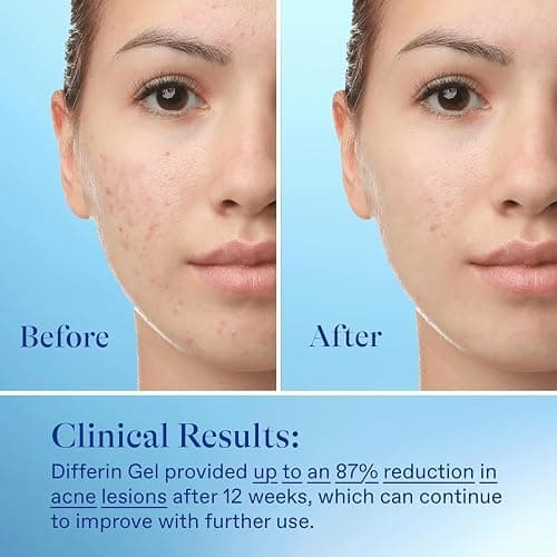 Differin Acne Treatment Gel, 30 Day Supply, Retinoid Treatment for Face with 0.1% Adapalene, Gentle Skin Care for Acne Prone Sensitive Skin, 15g Tube (Packaging May Vary) thumbnail 9