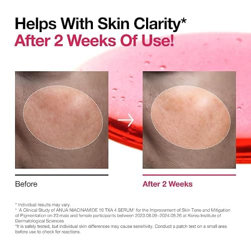 ANUA Niacinamide 10 + TXA 4 Serum, Hyaluronic Acid, Tranexamic acid, Facial Serum For GlassSkin, Cardi B’s Pick, Glow Back Serum, Dark Spot Care, Postnatal Skincare, Korean Skincare (30ml/1.01 fl.oz) thumbnail 4