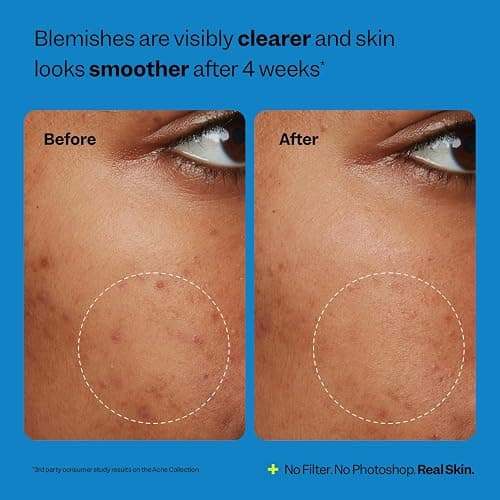 Peach Slices - Acne Oil-Free Moisturizer (2.82 oz) - 2% Salicylic Acid Acne Treatment - Clear & Prevent Breakouts - Hyaluronic Acid, Niacinamide, Cica - Vegan, Cruelty Free, Korean Skin Care & Beauty thumbnail 6
