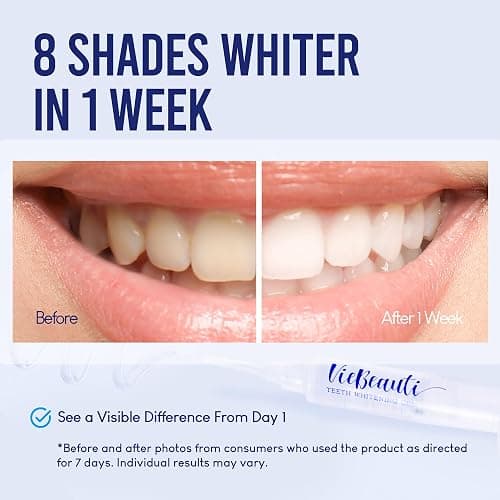 VieBeauti Teeth Whitening Kit with LED Light for Sensitive Teeth, 35% Carbamide Peroxide, Remineralizing Gel for Fast Results Mint thumbnail 2