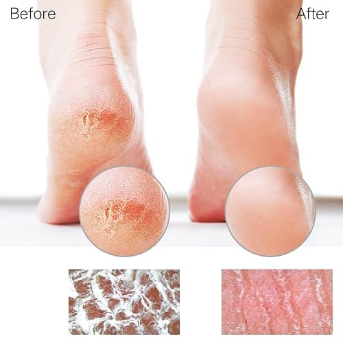 Sunivaca Glass Foot File Callus Remover for Feet, Heel Scraper, Pumice Stone, Diabetic Feet Scrubber Dead Skin Remover for Feet Professional Pedicure Tools thumbnail 4